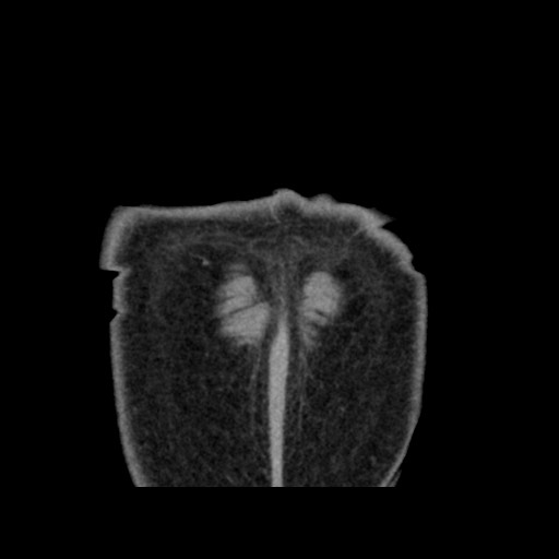 Chondrosarcoma of iliac wing (Radiopaedia 63861-72599 Coronal non-contrast 112).jpg