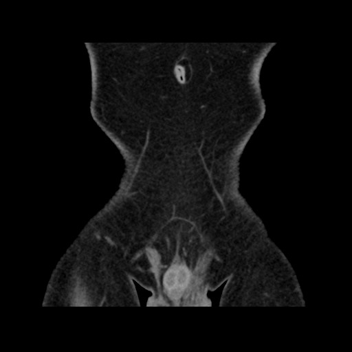 File:Chondrosarcoma of iliac wing (Radiopaedia 63861-72599 Coronal non-contrast 18).jpg