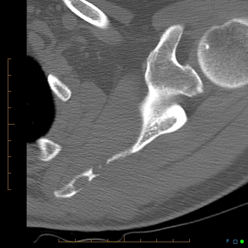 File:Chondrosarcoma of the scapula (Radiopaedia 30696-31399 Axial non-contrast 7).jpg