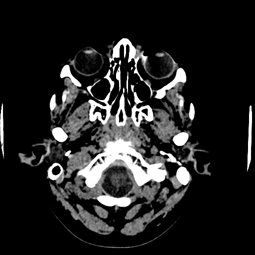 File:Choroid plexus xanthogranulomas (Radiopaedia 51621-57408 Axial non-contrast 6).jpg