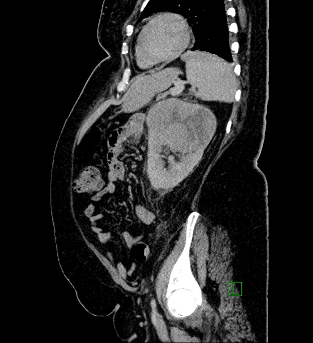 Chromophobe renal cell carcinoma (Radiopaedia 84239-99519 G 34).jpg
