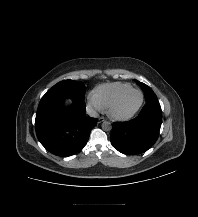 Chromophobe renal cell carcinoma (Radiopaedia 84337-99644 Axial non-contrast 1).jpg