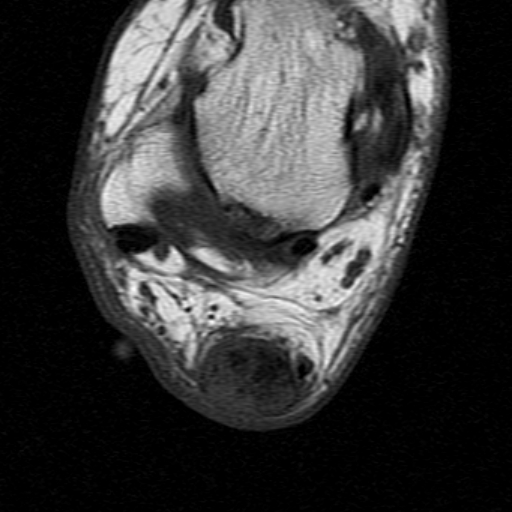 File:Chronic Achilles tendon rupture (Radiopaedia 15262-15100 Axial T1 16).jpg