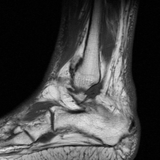 File:Chronic Achilles tendon rupture (Radiopaedia 15262-15100 Sagittal T1 2).jpg