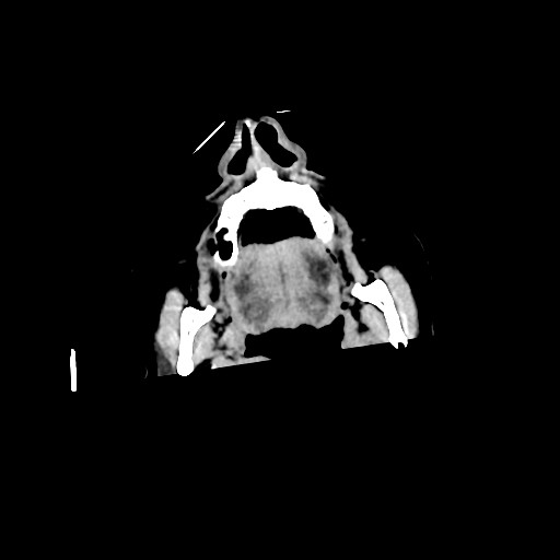 Chronic bilateral subdural hygroma (Radiopaedia 85801-101622 Axial non-contrast 9).jpg
