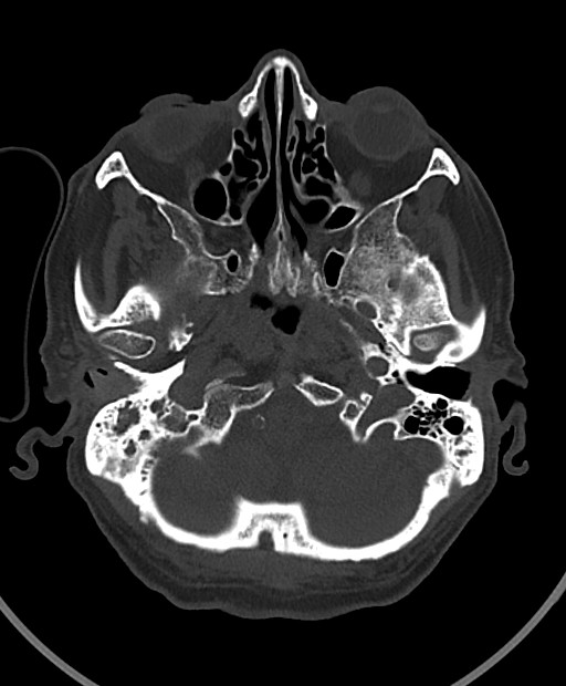 Chronic bilateral subdural hygroma (Radiopaedia 85801-101623 Axial bone window 100).jpg