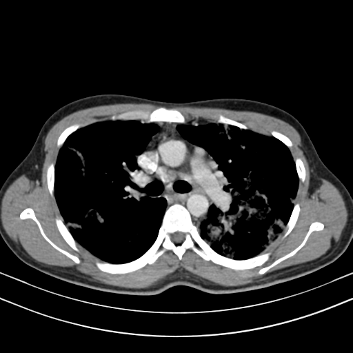 File:Chronic eosinophilic pneumonia (Radiopaedia 39331-41587 Axial C+ delayed 47).png