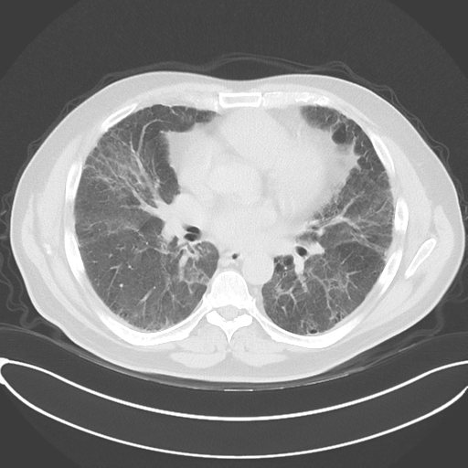 Chronic hypersensitivity pneumonitis (Radiopaedia 48107-52922 Axial lung window 34).png