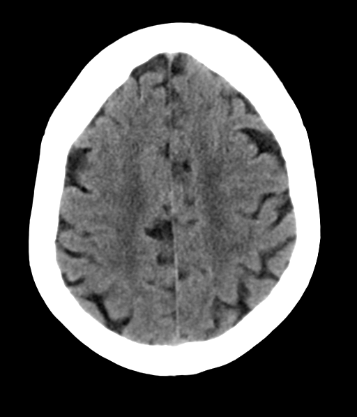 File:Chronic hypertensive encephalopathy (Radiopaedia 39993-42485 Axial non-contrast 25).png