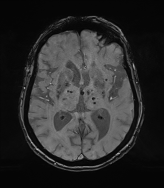 Chronic hypertensive encephalopathy (Radiopaedia 72844-83495 Axial SWI magnitude 43).png