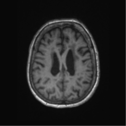 Chronic hypertensive encephalopathy (Radiopaedia 72844-83495 Axial T1 24).png