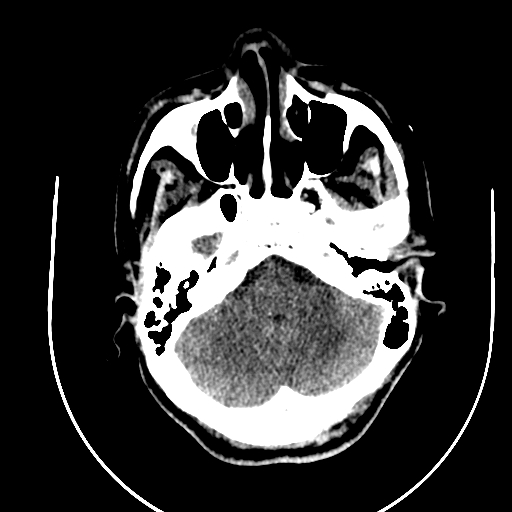 Chronic invasive fungal sinusitis (Radiopaedia 91563-109286 Axial non-contrast 15).jpg