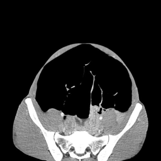 Chronic large bowel pseudo-obstruction (Radiopaedia 43181-46492 A 132).jpg