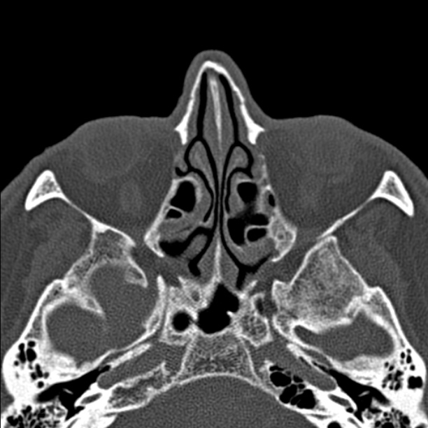Chronic maxillary sinusitis (Radiopaedia 27879-28116 Axial bone window 27).jpg