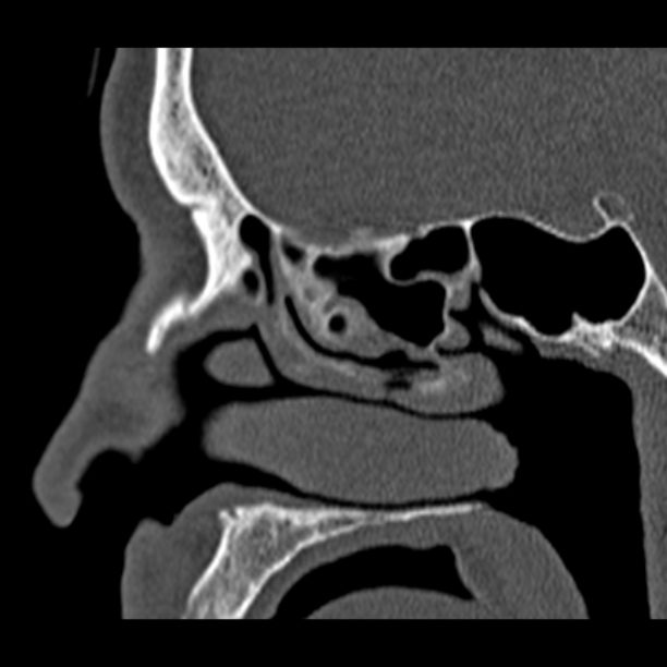 Chronic maxillary sinusitis (Radiopaedia 27879-28116 Sagittal bone window 31).jpg