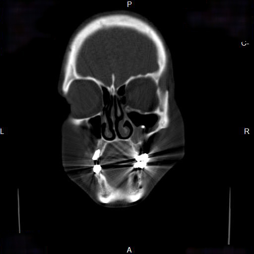File:Chronic maxillary sinusitis with a foreign body (dental filling material) (Radiopaedia 7811-8639 Coronal bone window 4).jpg