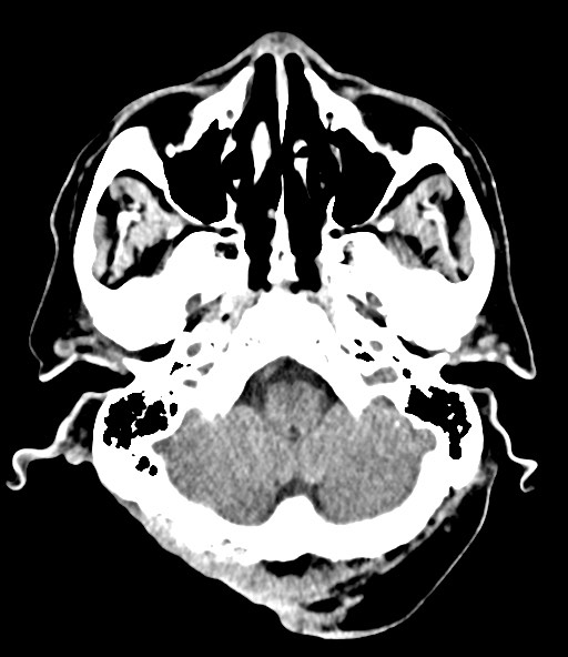 File:Chronic osteomyelitis - calvarial (severe) (Radiopaedia 69668-79616 Axial non-contrast 29).jpg