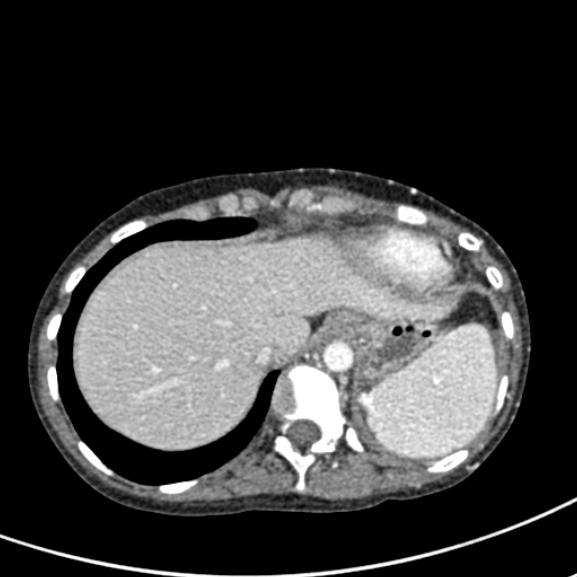 Chronic pancreatitis (Radiopaedia 55405-61846 A 16).jpg