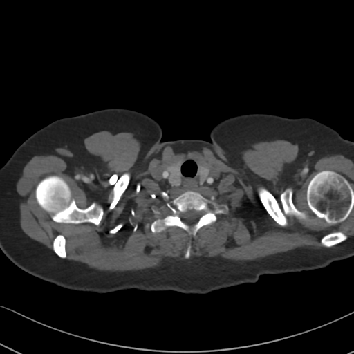 Chronic pulmonary embolus (Radiopaedia 39129-41341 Axial C+ CTPA 6).png