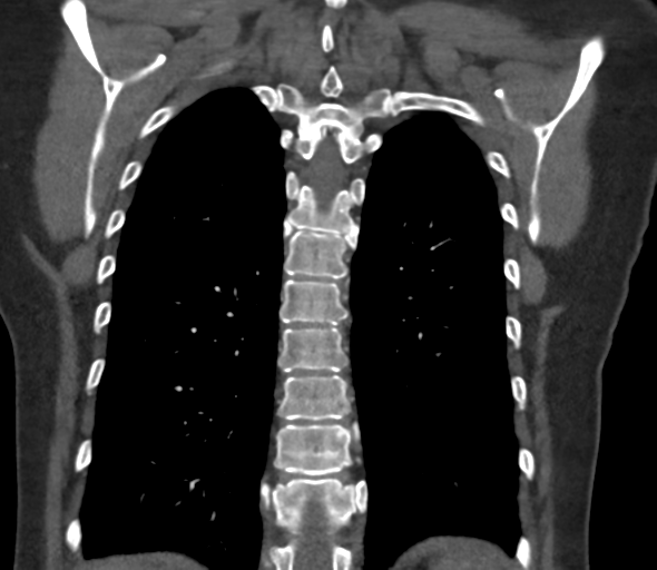 Chronic pulmonary embolus (Radiopaedia 39129-41341 Coronal C+ CTPA 66).png