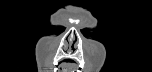 Chronic sphenoidal sinusitis (Radiopaedia 62030-70122 Coronal bone window 4).jpg