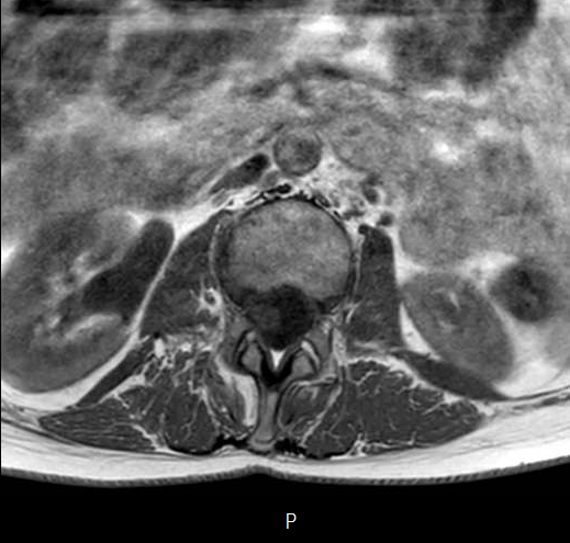File:Chronic spinal hematoma with cauda equina syndrome (Radiopaedia 75745-87090 Axial T1 8).png