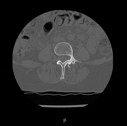 Chronic spinal hematoma with cauda equina syndrome (Radiopaedia 75745-88197 Axial bone window 30).png