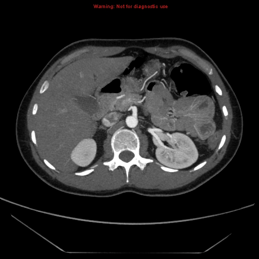 File:Circumaortic left renal vein (Radiopaedia 9069-9792 A 12).jpg