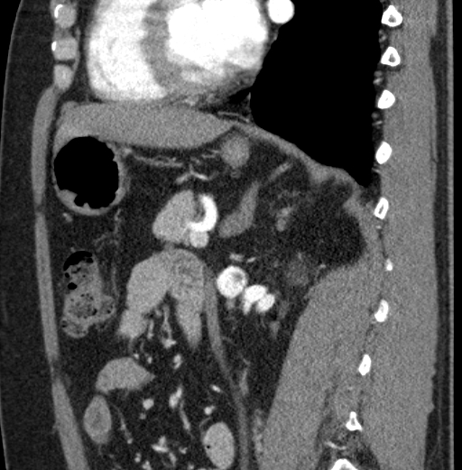 File:Clear cell renal cell carcinoma (Radiopaedia 61449-69393 D 43).jpg