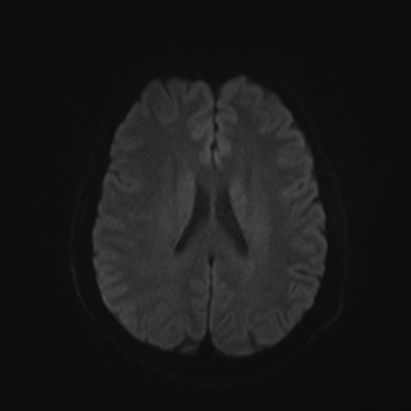 File:Clival meningioma (Radiopaedia 53278-59248 Axial DWI 41).jpg