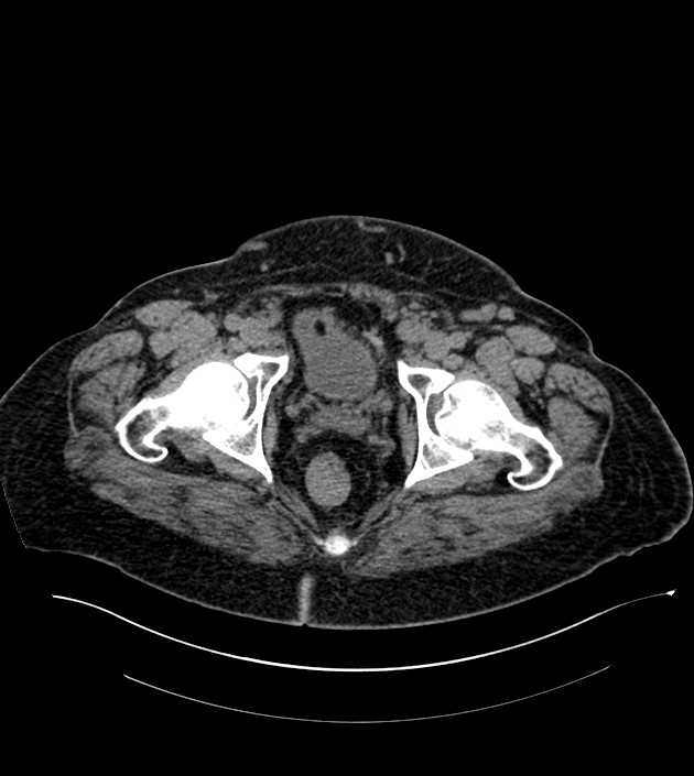 Closed-loop small bowel obstruction-internal hernia (Radiopaedia 78439-91096 Axial non-contrast 148).jpg