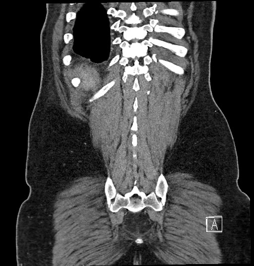 Closed loop obstruction - internal hernia into nephrectomy bed (Radiopaedia 59867-67320 B 126).jpg