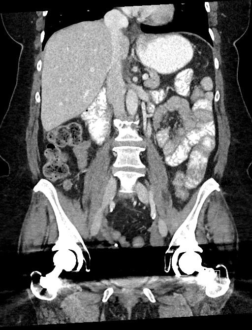 Closed loop small bowel obstruction - adhesions (Radiopaedia 59078-66369 B 65).jpg