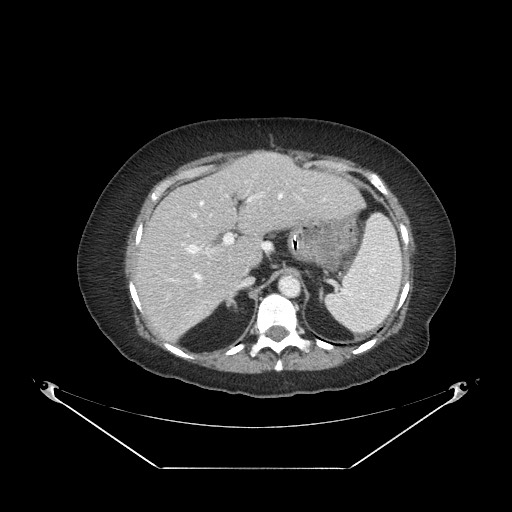 Closed loop small bowel obstruction - internal hernia (Radiopaedia 65402-74450 A 23).jpg