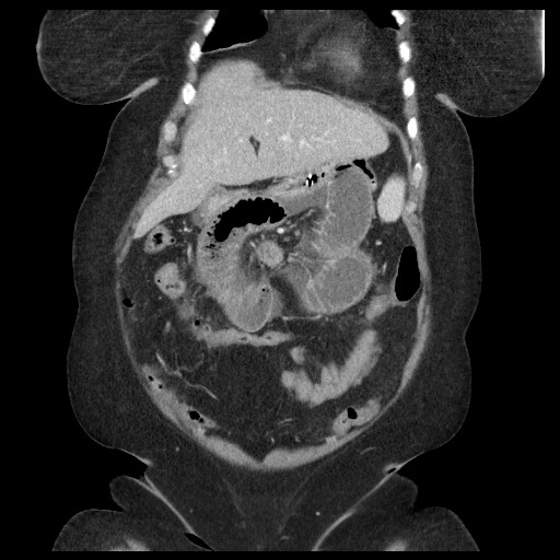 Closed loop small bowel obstruction - internal hernia (Radiopaedia 65402-74450 B 30).jpg