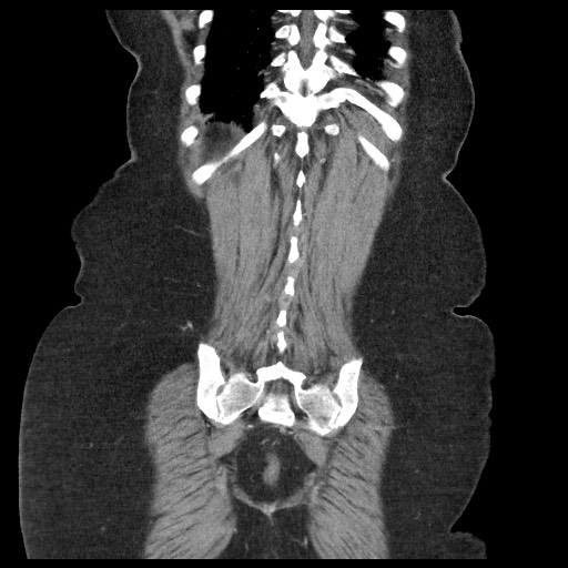 Closed loop small bowel obstruction - internal hernia (Radiopaedia 65402-74450 B 93).jpg