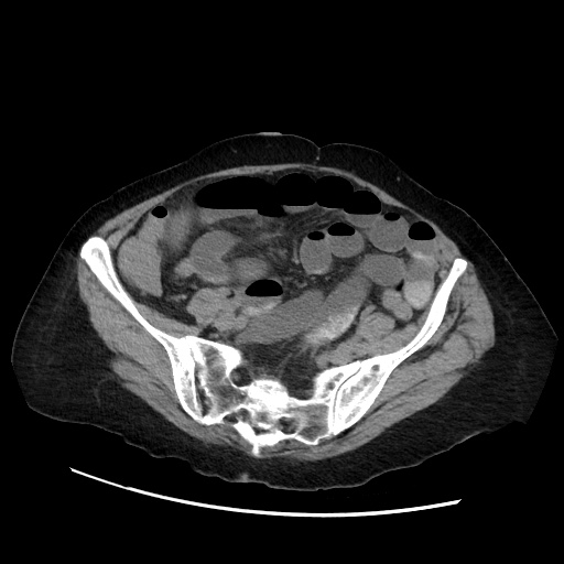 Closed loop small bowel obstruction due to adhesive band, with intramural hemorrhage and ischemia (Radiopaedia 83831-99017 Axial non-contrast 116).jpg