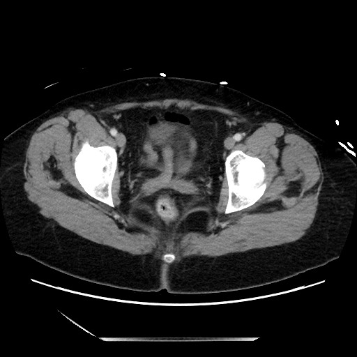 Closed loop small bowel obstruction due to adhesive bands - early and late images (Radiopaedia 83830-99014 A 142).jpg
