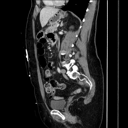 File:Closed loop small bowel obstruction due to adhesive bands - early and late images (Radiopaedia 83830-99014 C 108).jpg
