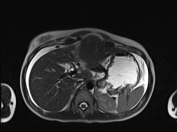 File:Closed loop small bowel obstruction in pregnancy (MRI) (Radiopaedia 87637-104031 Axial T2 17).jpg