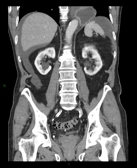 Closed loop small bowel obstruction with ischemia (Radiopaedia 84180-99456 B 24).jpg