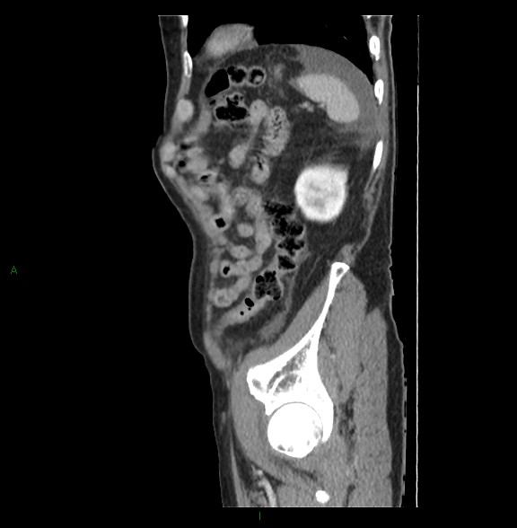 Closed loop small bowel obstruction with ischemia (Radiopaedia 84180-99456 C 75).jpg