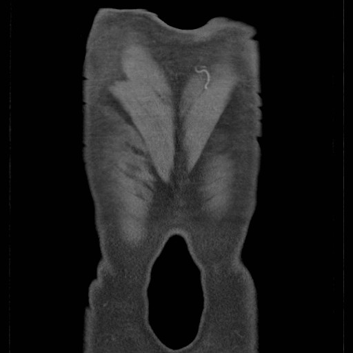 Coarctation of the aorta (Radiopaedia 17427-17116 A 5).jpg