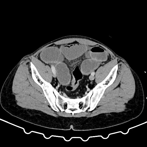 File:Colocolic intussusception due to large lipoma (Radiopaedia 68773-78482 A 157).jpg