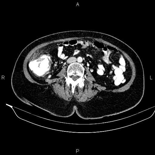 Colon adenocarcinoma (Radiopaedia 91240-108842 A 52).jpg
