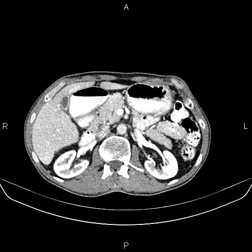 Colon adenocarcinoma - hepatic flexure (Radiopaedia 85635-101395 A 31).jpg