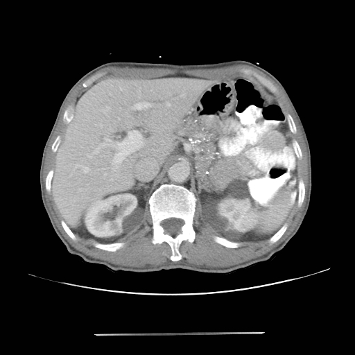 Colon cancer with calcified liver metastasis (Radiopaedia 74423-85307 A 21).jpg