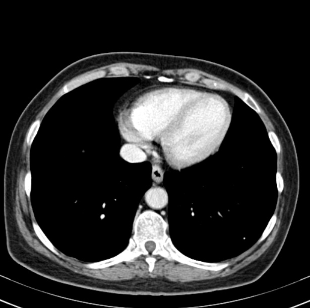 Colon carcinoma with hepatic metastases (Radiopaedia 29477-29961 A 6).jpg