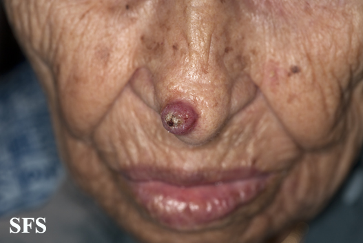 File:Keratoacanthoma (Dermatology Atlas 61).jpg