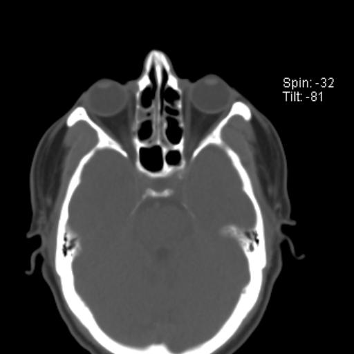 File:Nasolabial cyst (Radiopaedia 28401-28650 Axial bone window 6).jpg